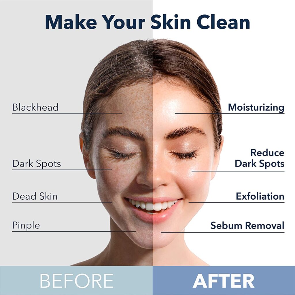 Acne Care Secrets Revealed: Keep Skin Acne Free With These Tips